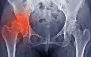 X-ray of a hip with arthritis