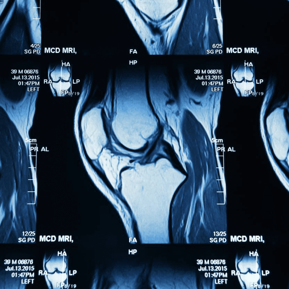 Meniscus Tear Repair Clinic Lateral & Medial Meniscus Tear