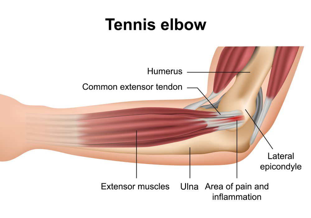 A diagram of tennis elbow