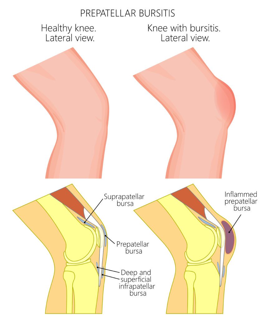 A diagram of housemaid's knee and prepatellar bursitis