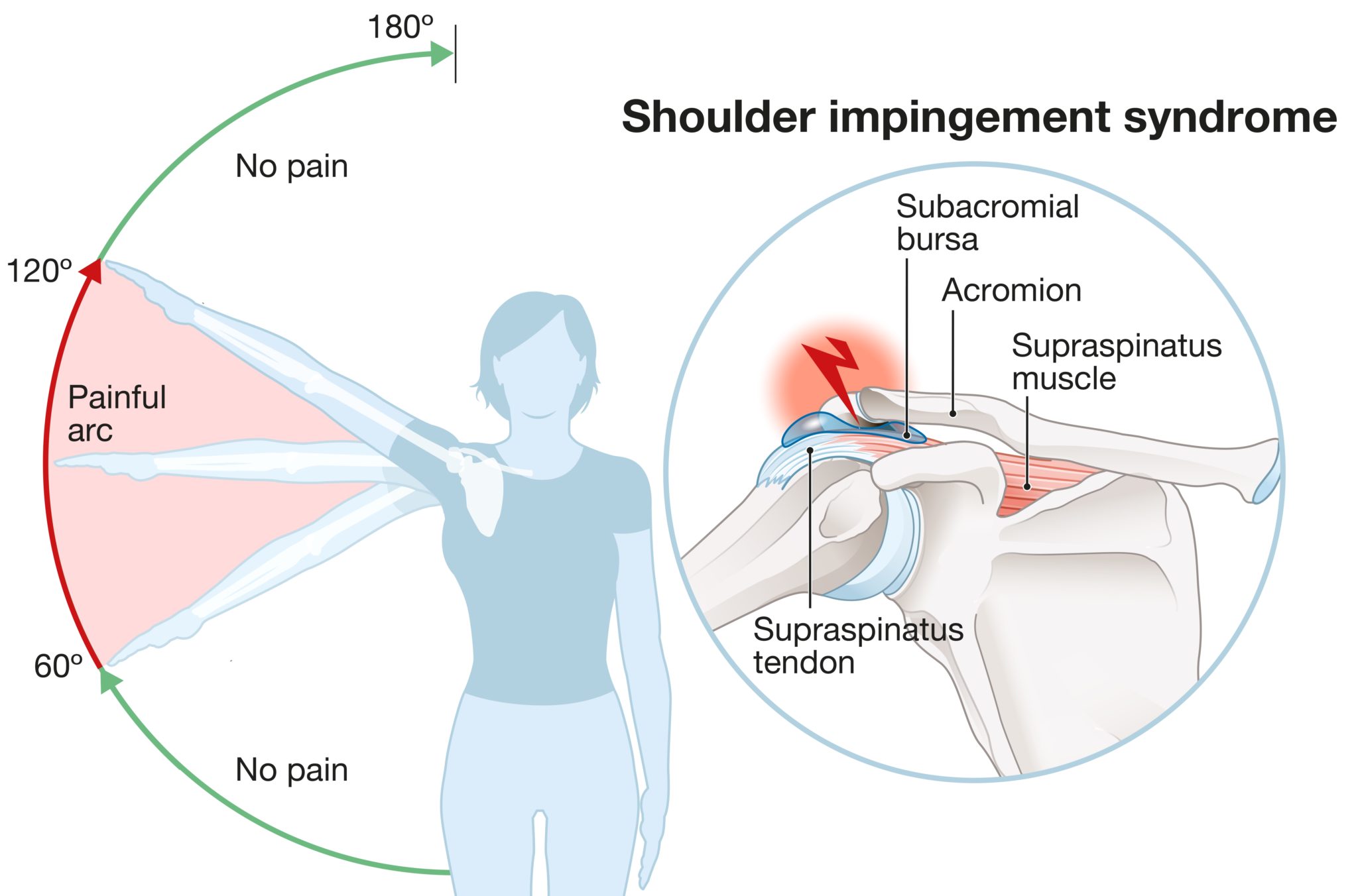 Painful Arc Causes Symptoms And Effective Treatments Painful Arc Causes Symptoms And Effective Treatments