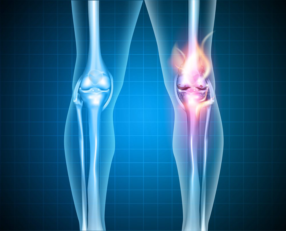 Image of burning and stabbing pain in the knee