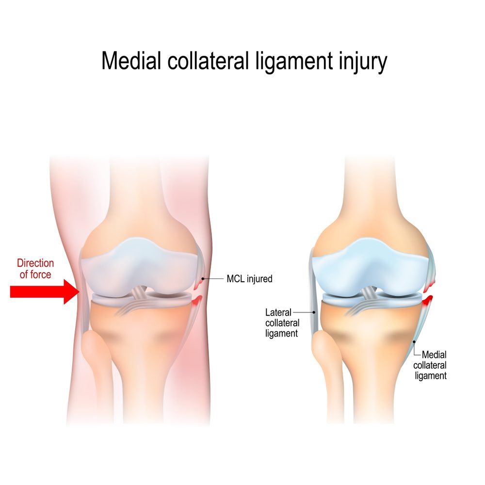 An MCL injury diagram