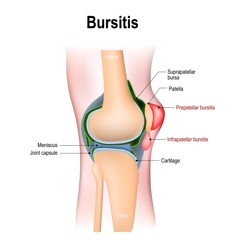 A diagram of infrapatellar bursitis
