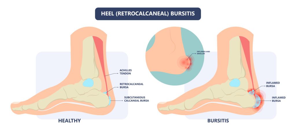 A diagram of ankle bursitis