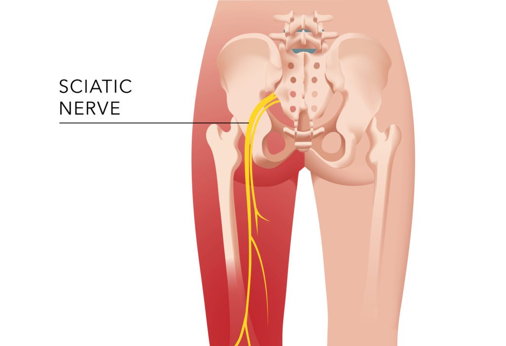 Sciatic nerve as a cause of buttock pain