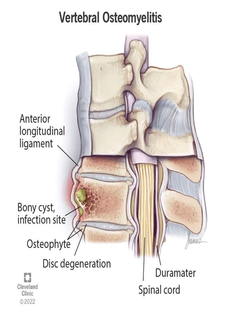 A diagram of vertebral osteomyelitis