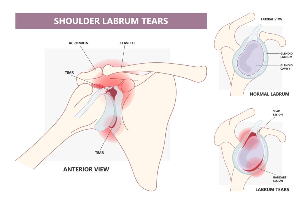 A diagram of a labrum tear that causes shoulder clicking.