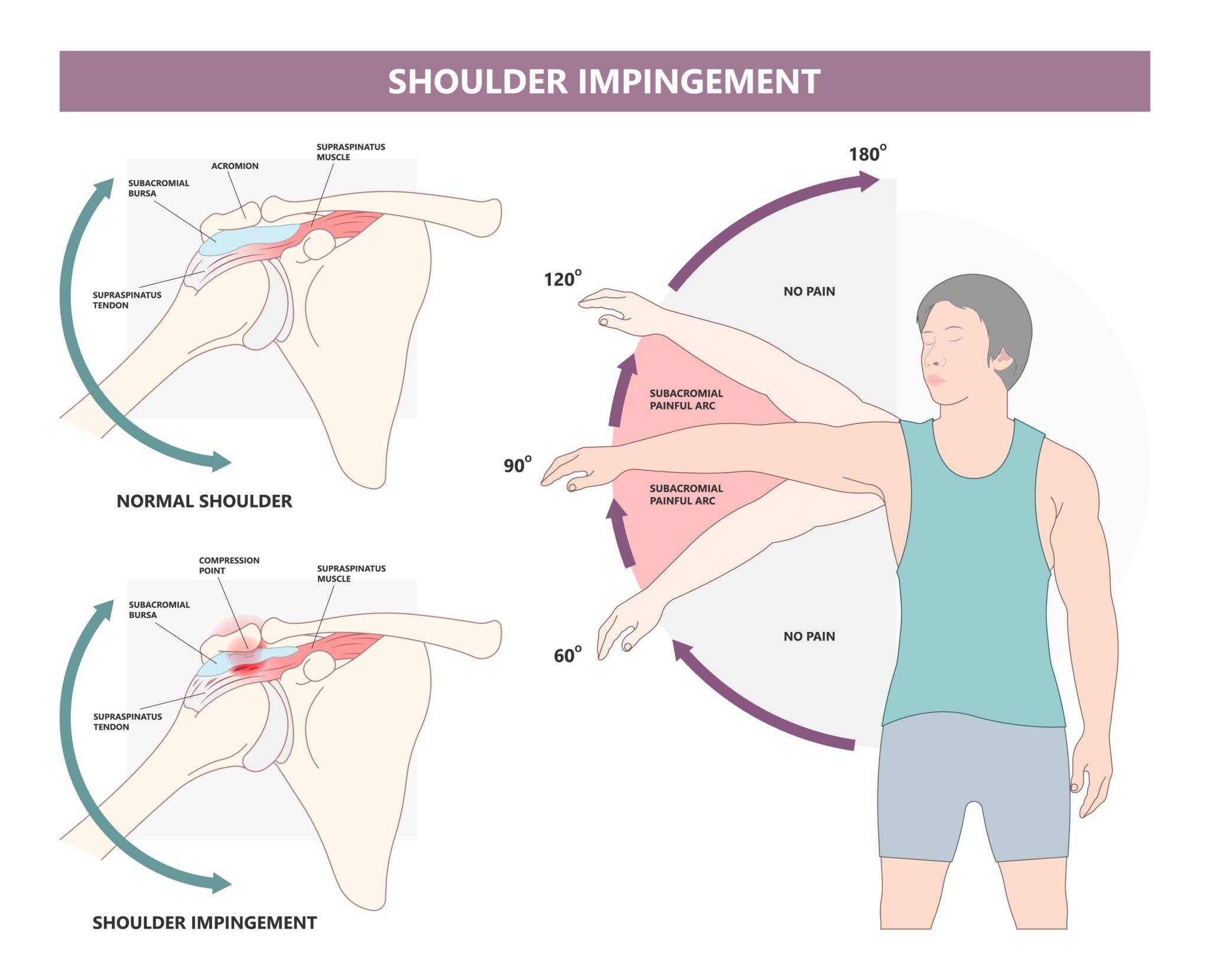 Printable Shoulder Impingement Exercises Printable Free Templates Printable Shoulder Impingement Exercises Printable Free Templates