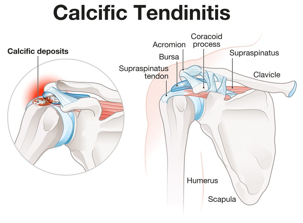 A diagram of calcific tendonitis