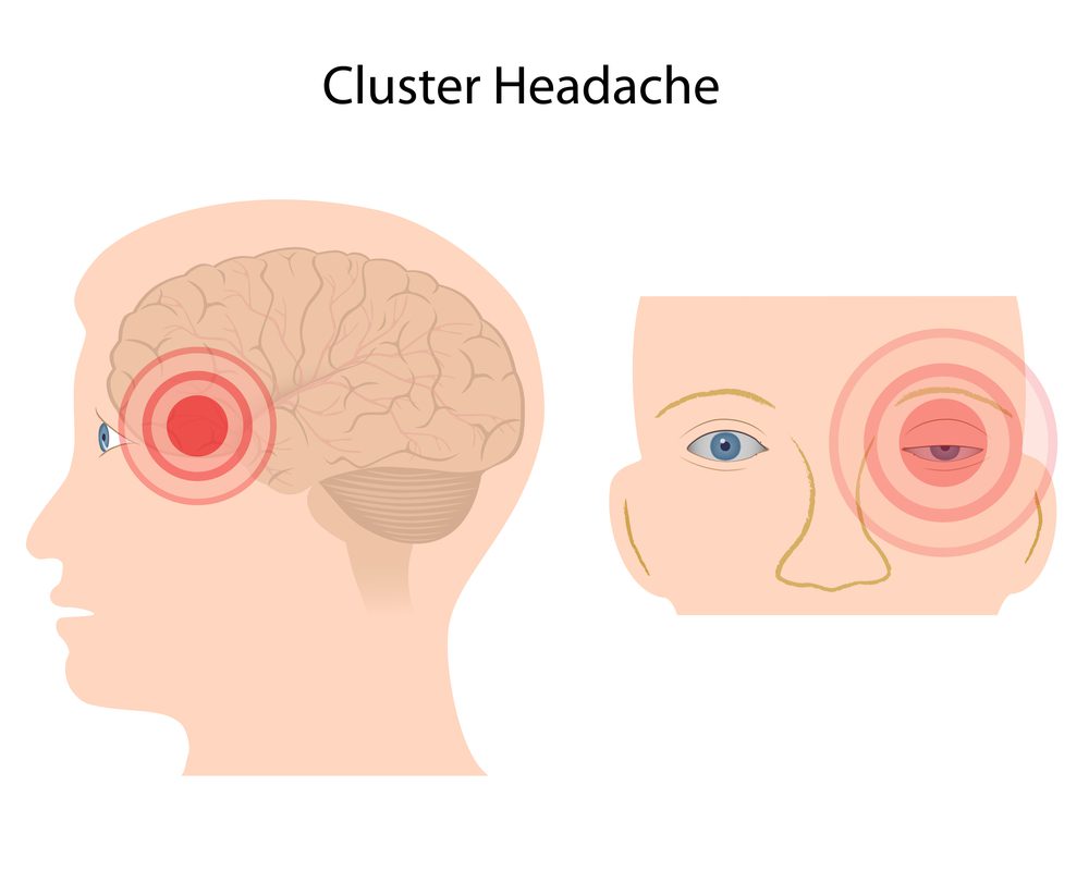 A cluster headache diagram