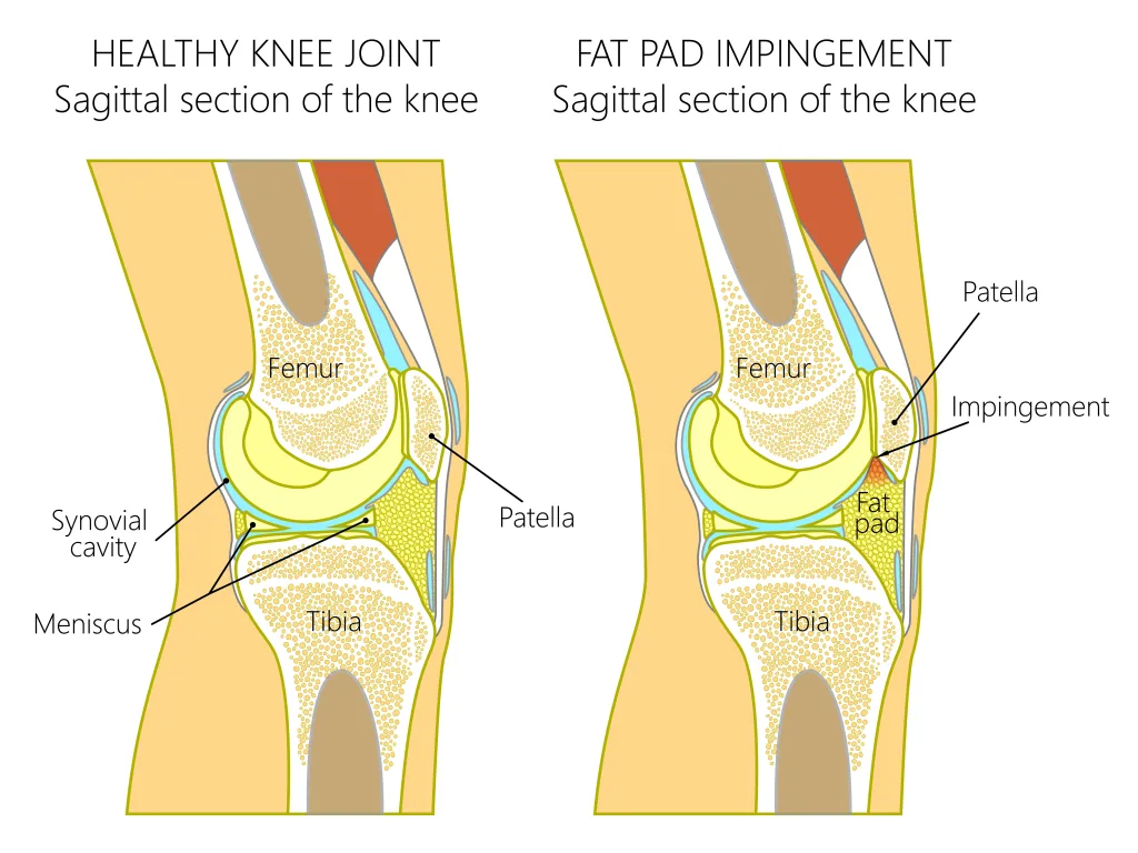 A diagram of fat pad impingement