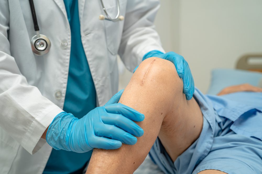 Man with scar from knee surgery to help his knee arthritis