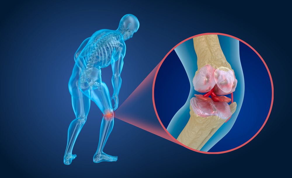 image depicting arthritis in a person's knee