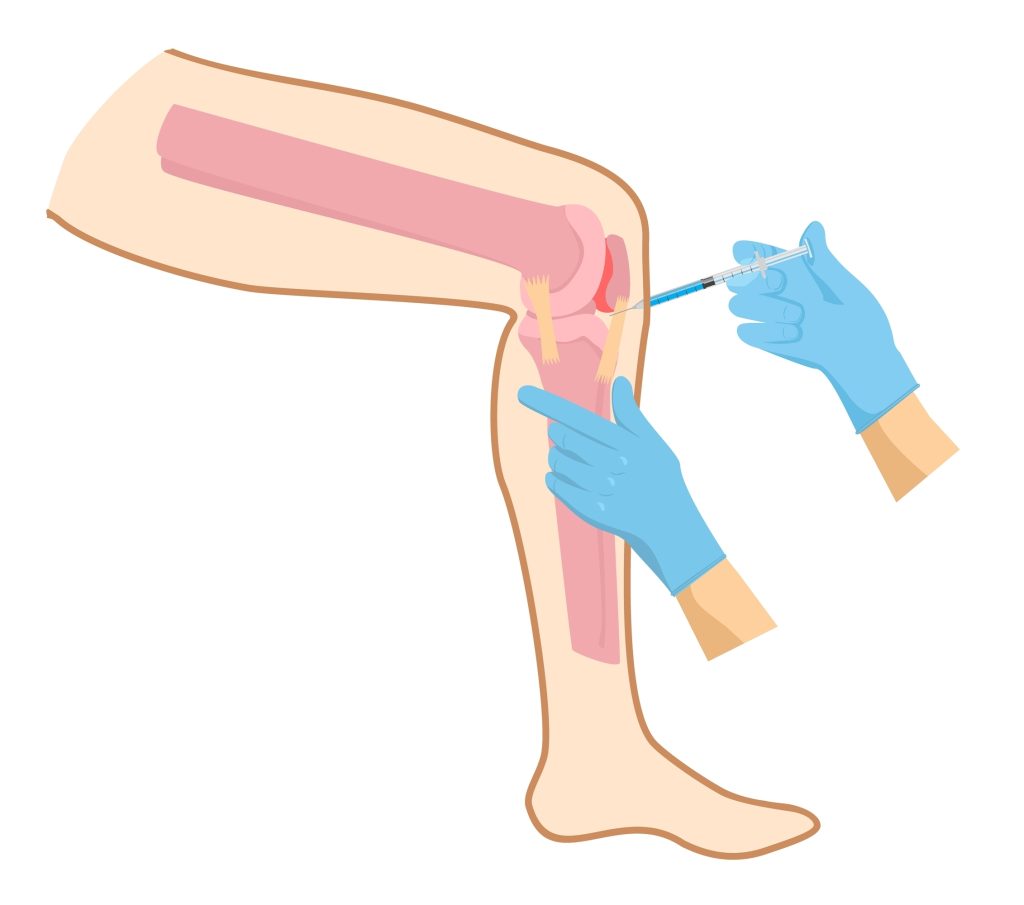 digital image of a knee being injected with steroids to help treat arthritis