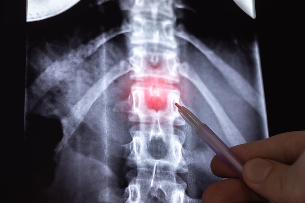 X-ray view of a herniated disc 