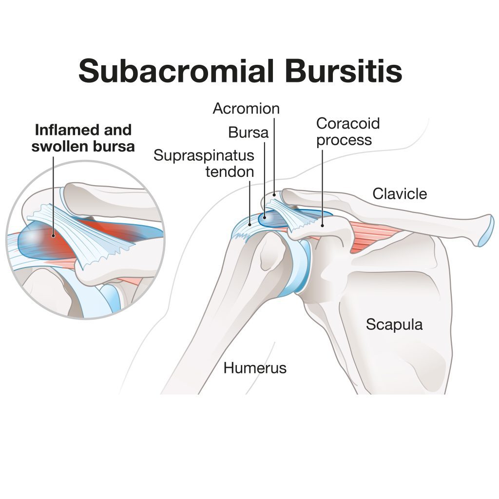 Subacromial Subdeltoid Bursitis Symptoms Treatment Exercises Subacromial Subdeltoid Bursitis Symptoms Treatment Exercises