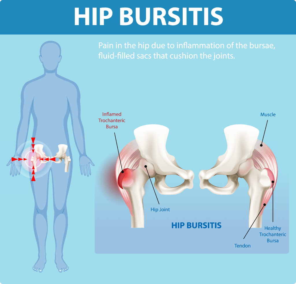 Diagram depicting hip bursitis