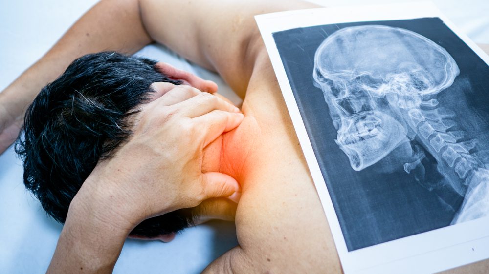 Xray of Cervical Spondylosis Xray image of Cervical Spondylosis next to someone's neck
