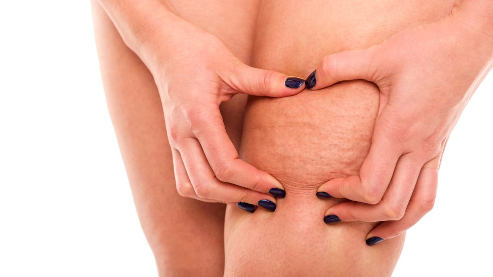 Cellulitis pain Cellulitis in the knee